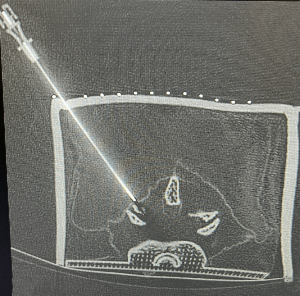 Lumbar puncture box CT