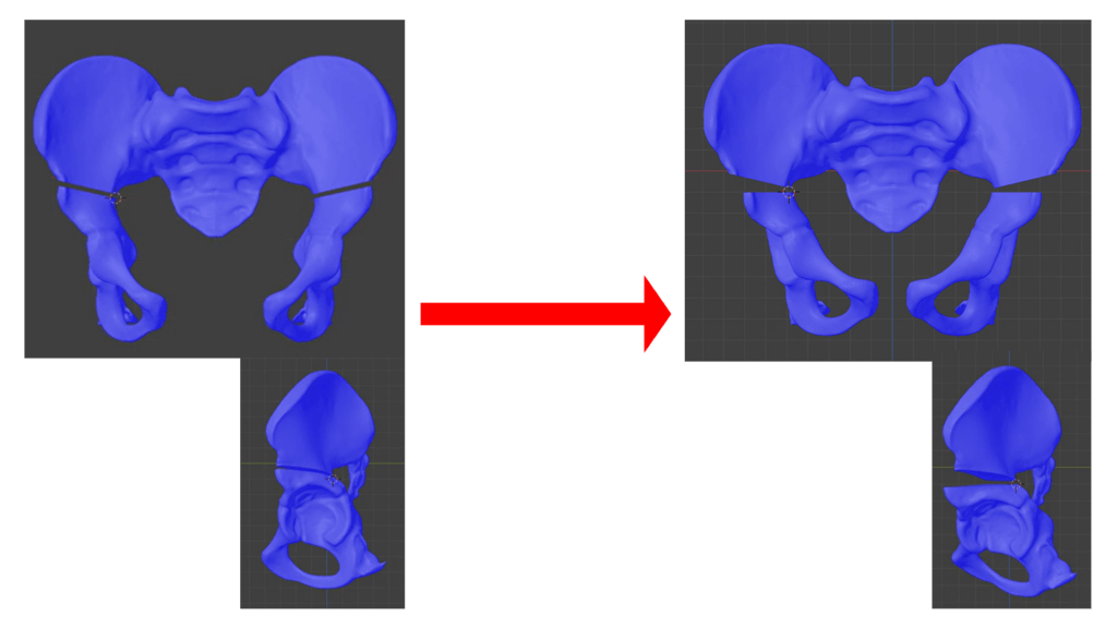 Osteotomy movement side by side comparison