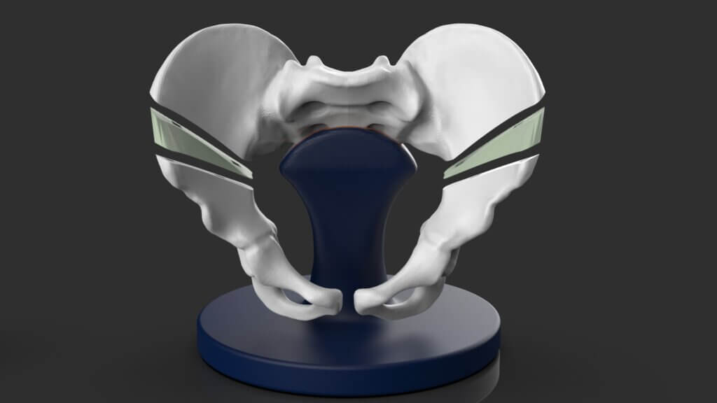 Render of a one osteotomy (oblique approach) model with stand