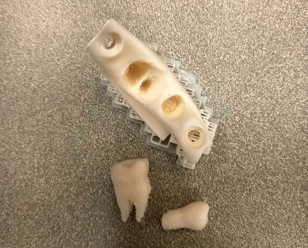 Broken root in 3D printed tooth module