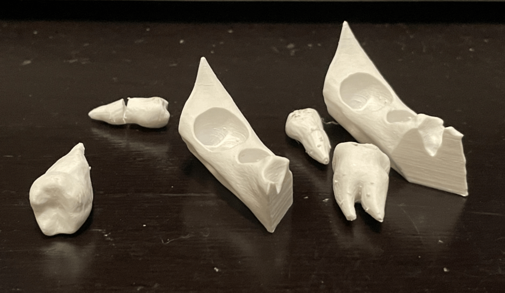 Test 3D printed teeth modules with extractions